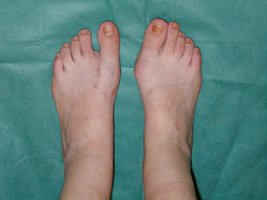 Deformations in the anterior part of the feet - after surgery
